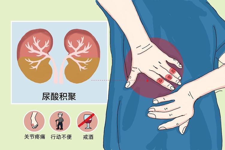 迷惑！为什么尿酸高的年轻人那么多？